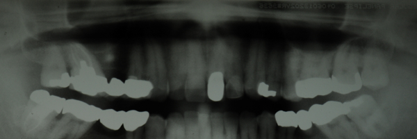Traditional Panoramic X-Ray